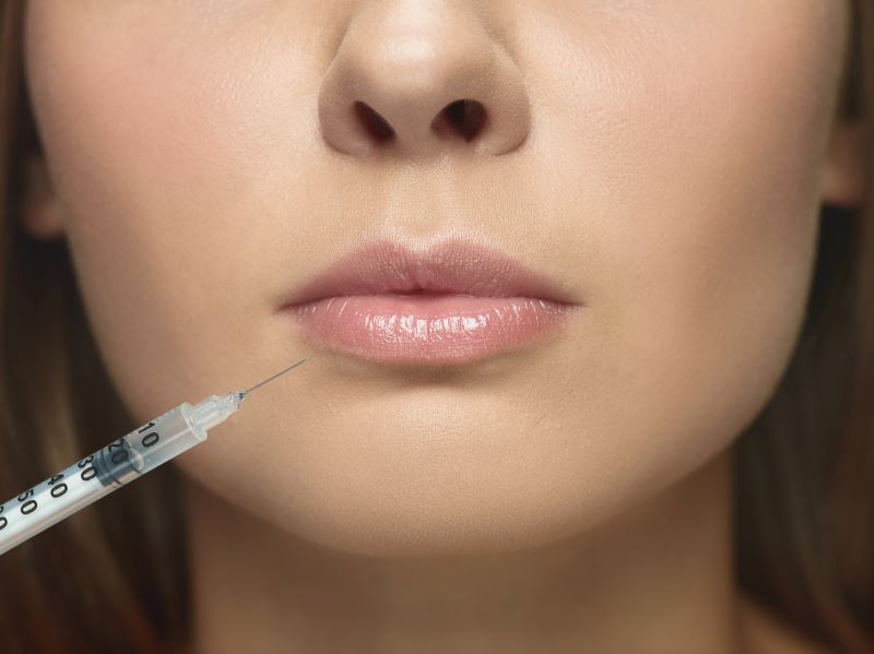 Leia mais sobre o artigo Preenchimento labial: entenda o que é e quais resultados pode proporcionar